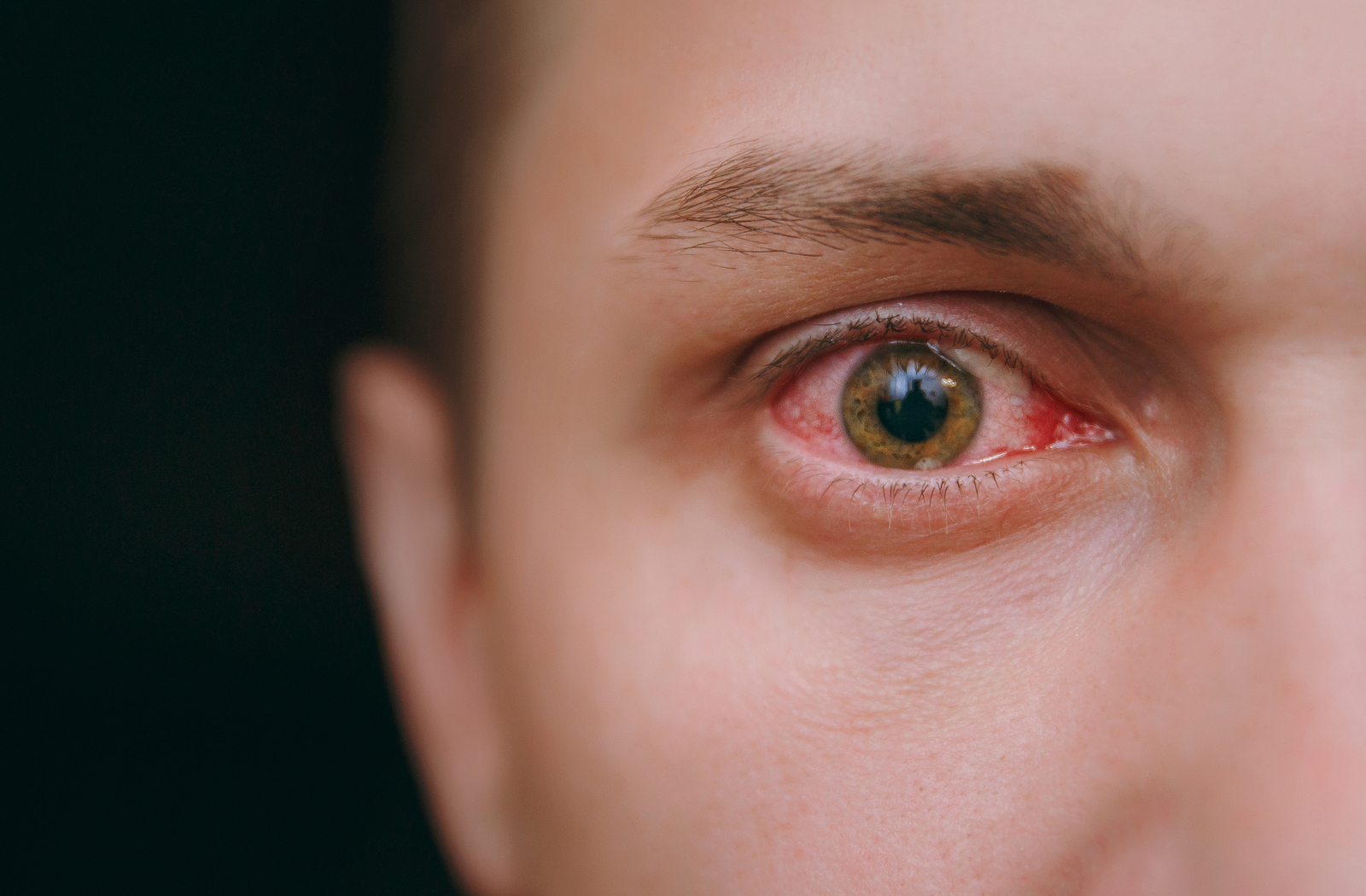 Close up of man with red eye due to dry eyes